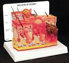 Skin Burn 1st-3rd Degree Model